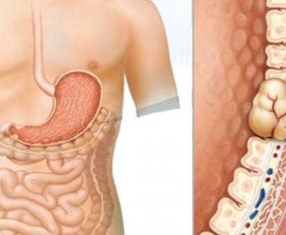 Khi nào nên đi khám bác sĩ nếu nghi ngờ mắc GIST?